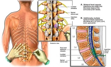 Epidural Anestezi ile Normal Doğum