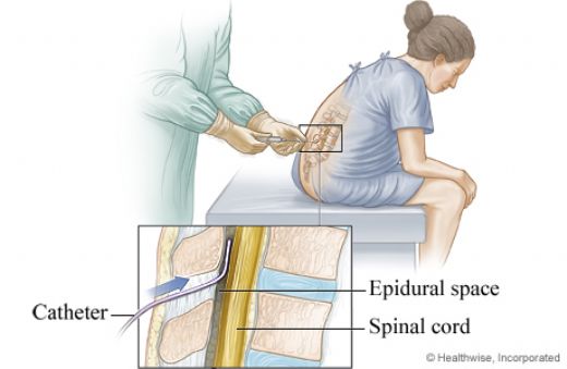 Epidural