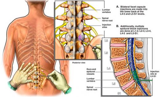 Epidural Anestezi le Normal Doum