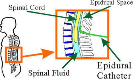 Epidural Anestezi Nasl Yaplr