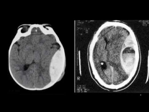 Epidural Hematom