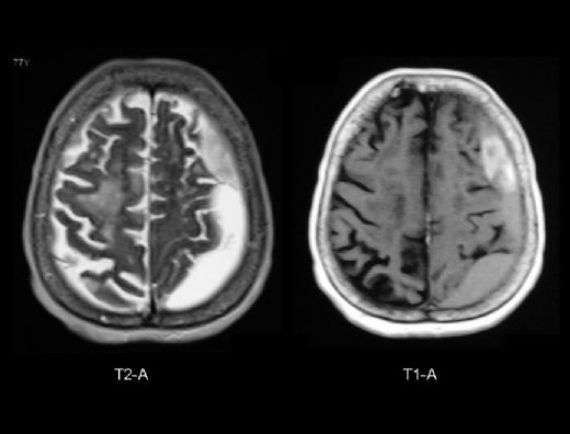 Epidural Kanama