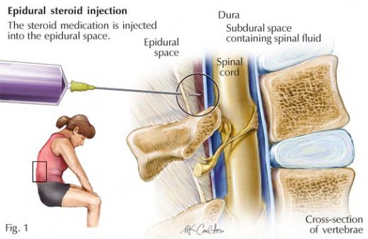 Epidural Steroid Enjeksiyonu